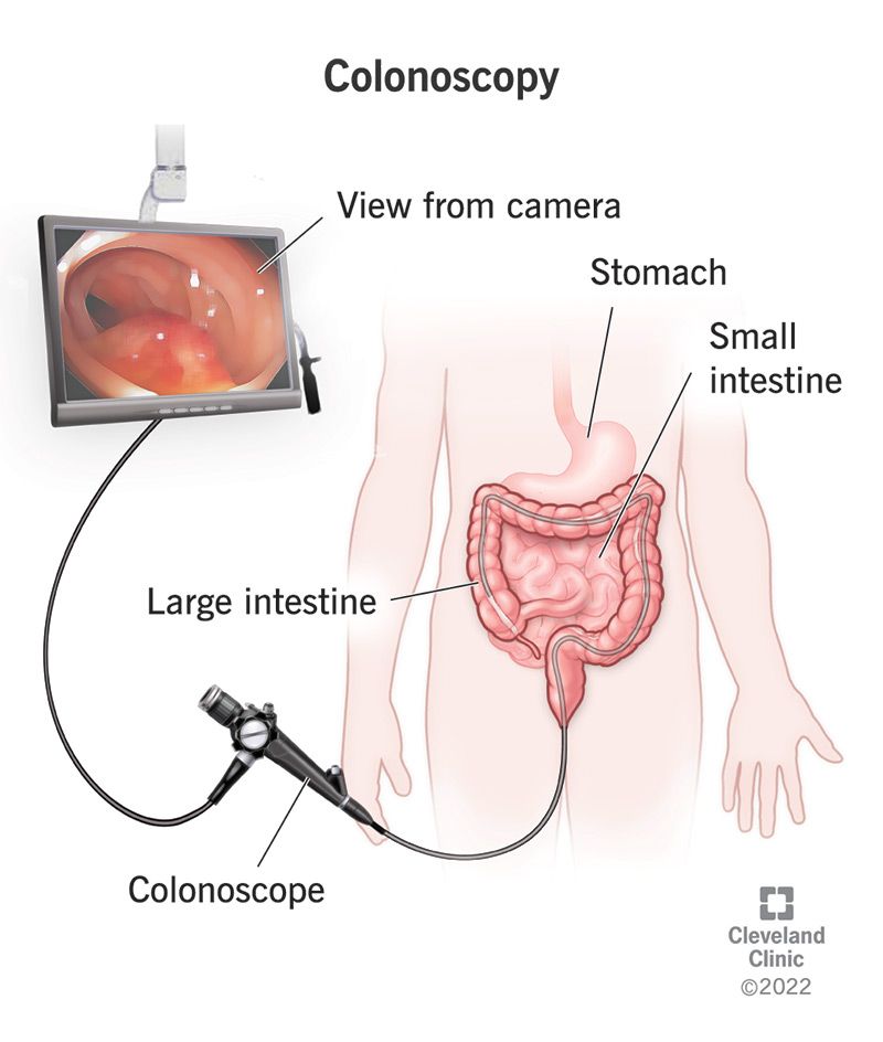 Colonoscopy for Women: When and Why